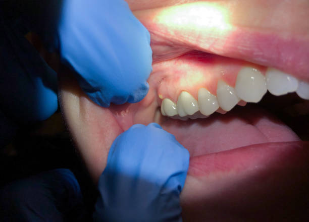 Best Urgent Tooth Repair  in Pewee Valley, KY